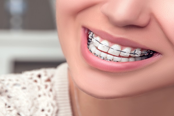 What Are Clear Braces?