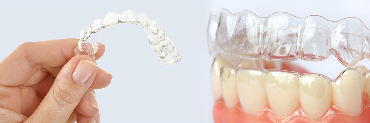 Bryan Alternative to Braces for Teens
