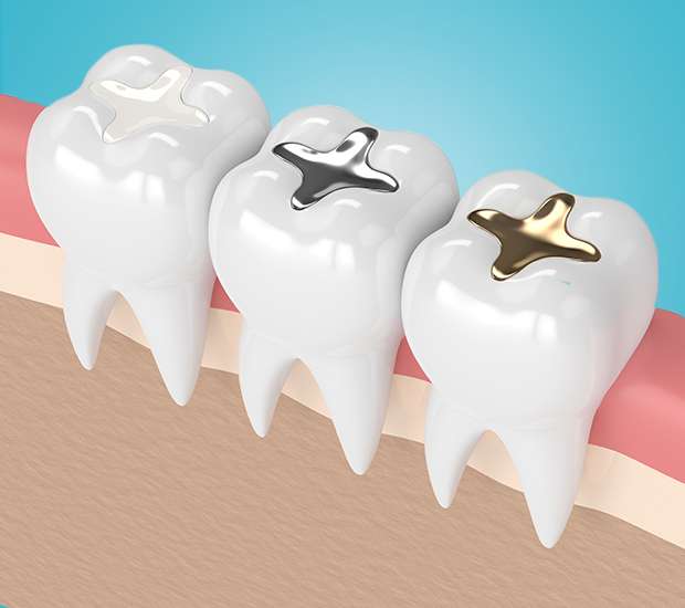 Bryan Tooth Colored Fillings