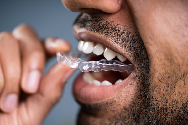 A Cosmetic Dentist Explains Benefits of Clear Aligners from Rivers Family Dentistry in Bryan, TX