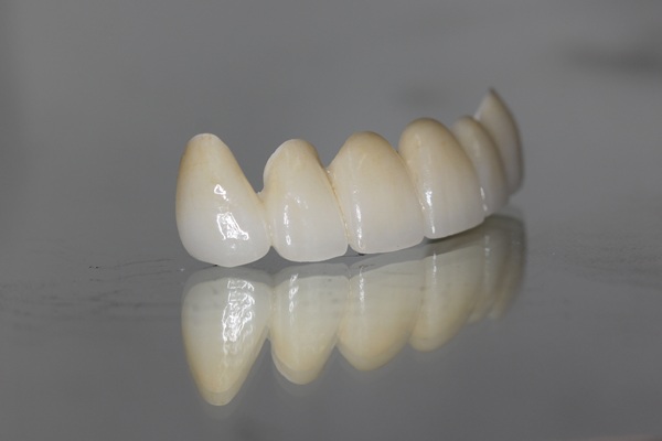 Why Dental Bridges Are Still A Smart Choice