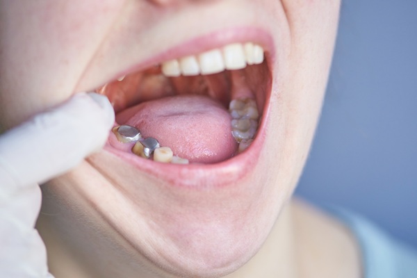 Understanding A Silver Versus Tooth Colored Dental Filling