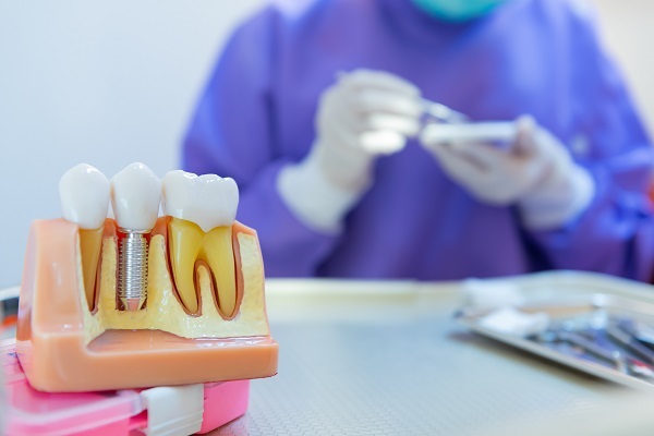 Options For Dental Implant Restoration After Damage