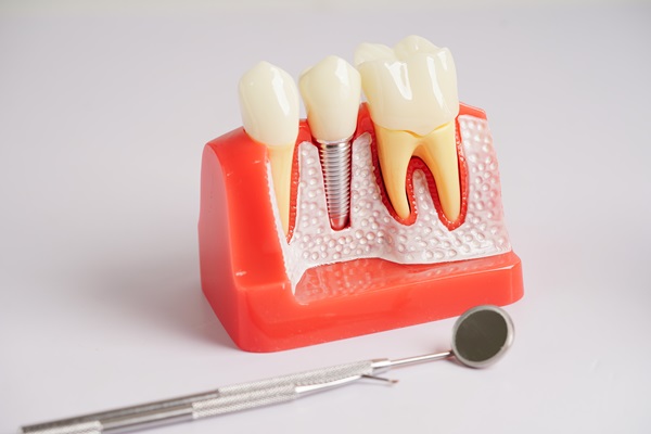Ways To Extend The Life Of Dental Implants