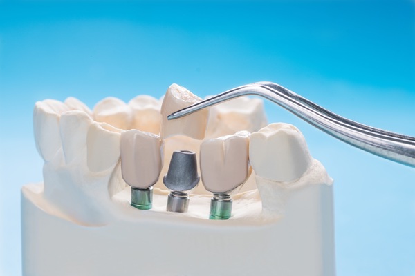 Dental Implants: A Solution For Missing Teeth