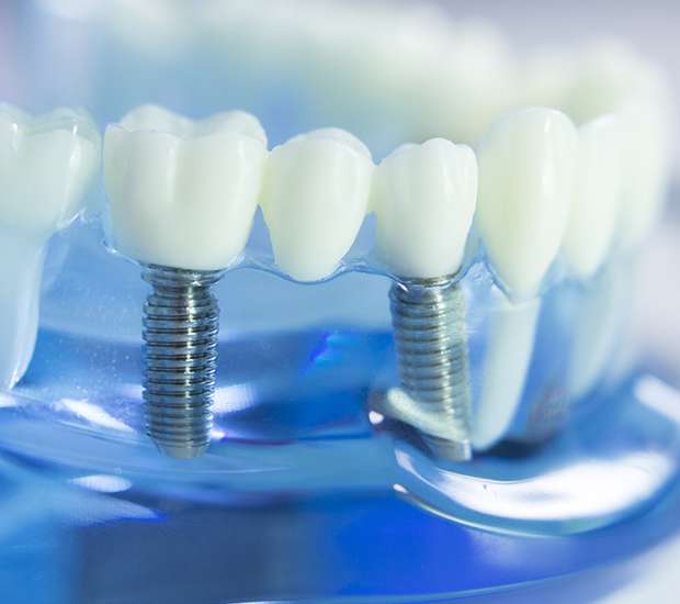 Bryan Dental Implants