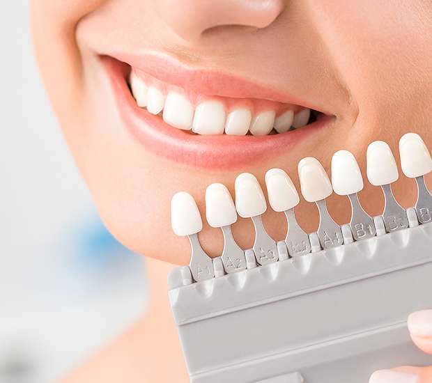 Bryan Dental Veneers and Dental Laminates