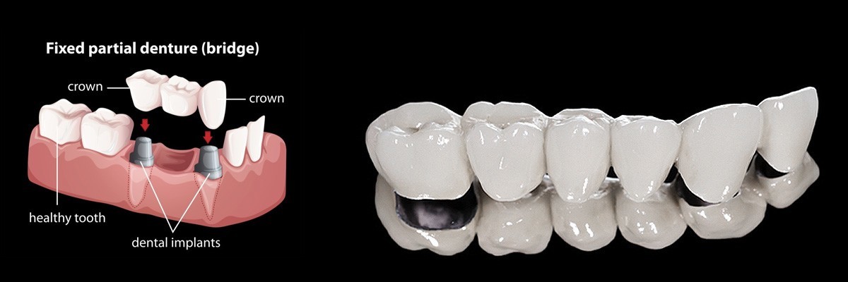 Bryan Dentures