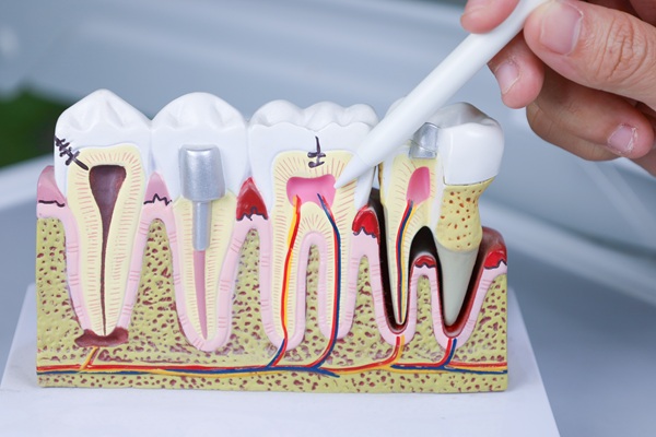 Endodontics    : What Really Happens During A Root Canal