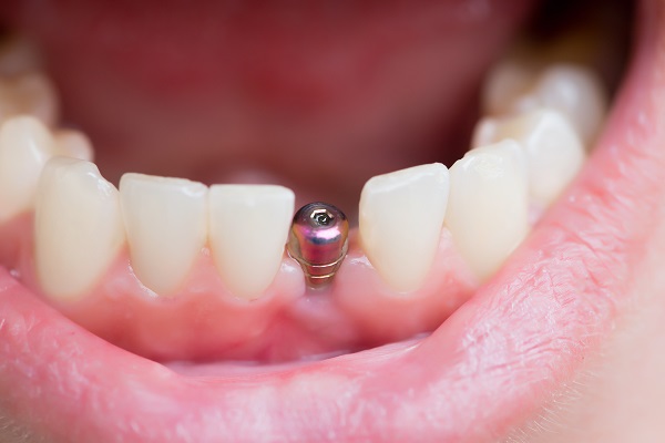 Questions To Ask An Experienced Implant Dentist